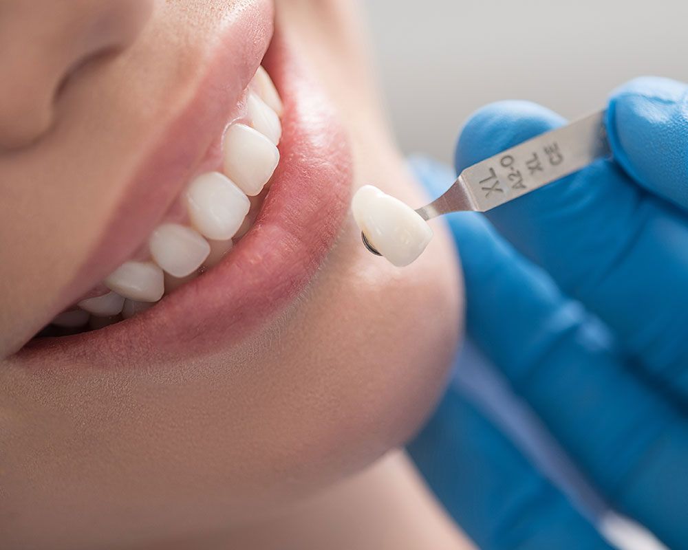 Veneer - Nahaufnahme